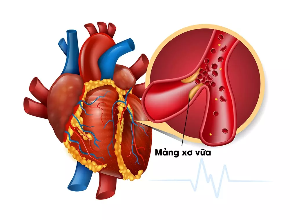 Mạch vành là mạch máu quan trọng nuôi dưỡng cho tế bào cơ tim.webp
